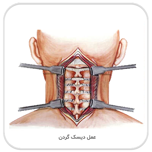 عمل دیسک گردن